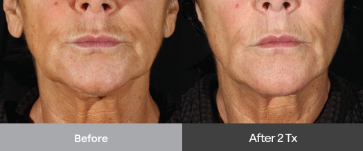 xerf skin tightening brisbane