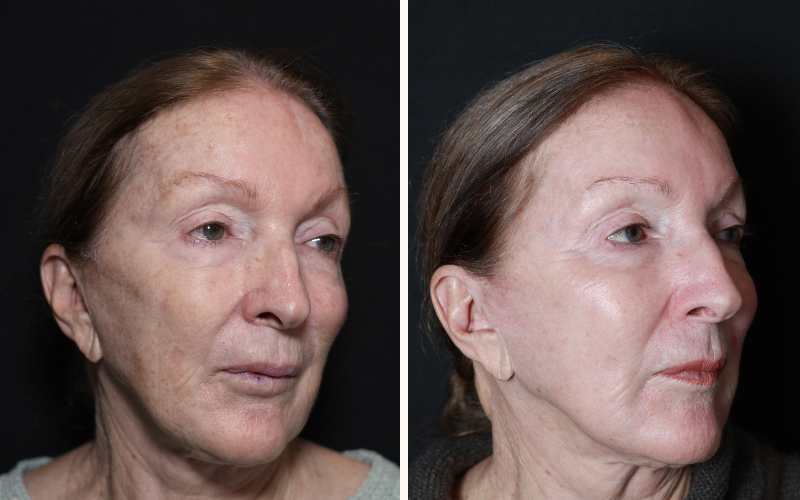 LaseMD skin resurfacing Brisbane before and after