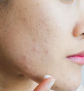 Face treatment area for CO2 laser resurfacing at DERM Skin Specialists