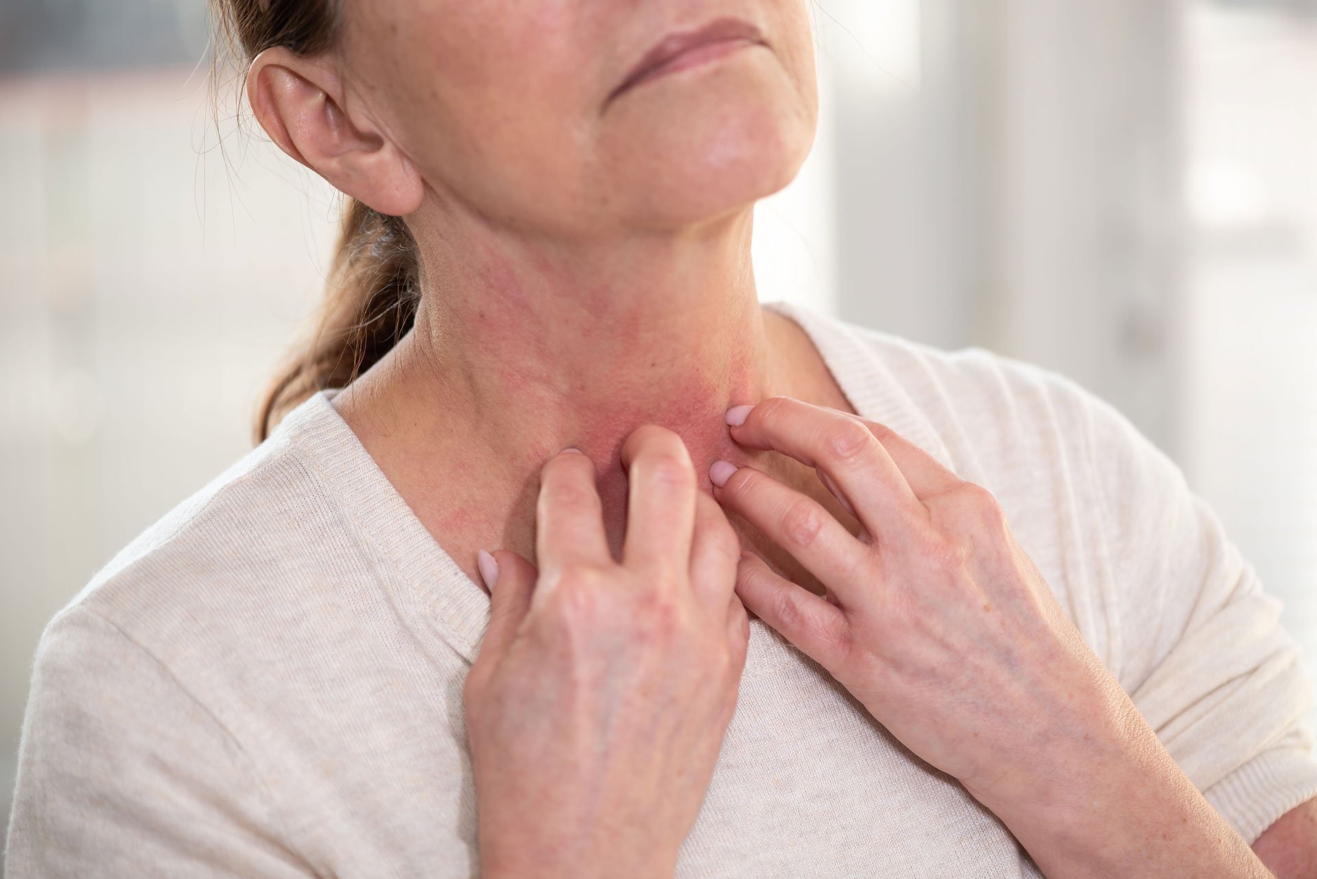 what is eczema