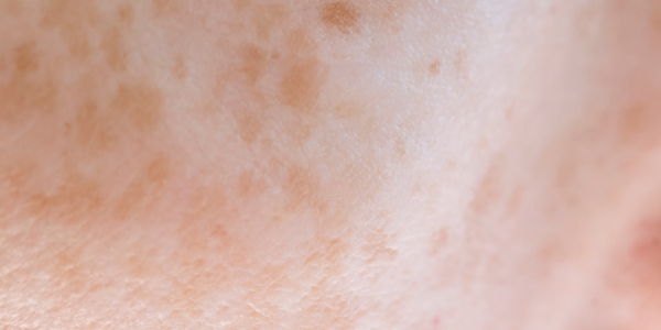 Sun Spot Laser Treatment
