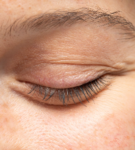 Close-up of the eyelids and under-eye area, where xanthelasma plaques form