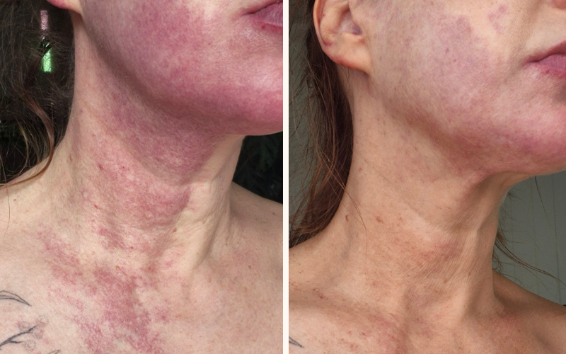 Rosacea port wint stain treatment brisbane