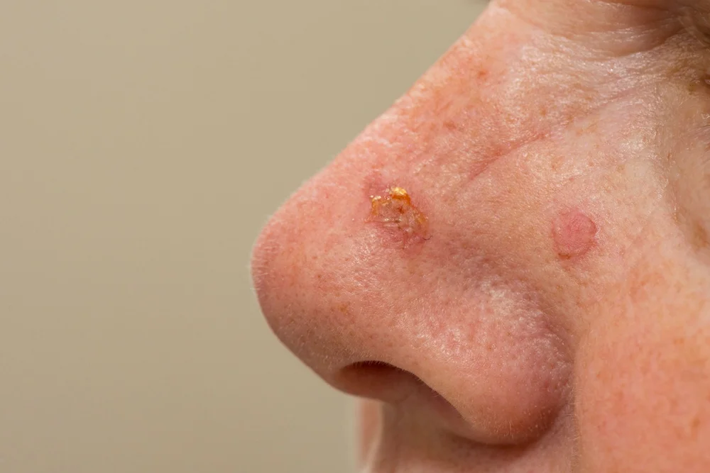 Scaly, sun-damaged spots on the side of the nose, assessed for PDT at DERM Skin Specialists, Mount Gravatt