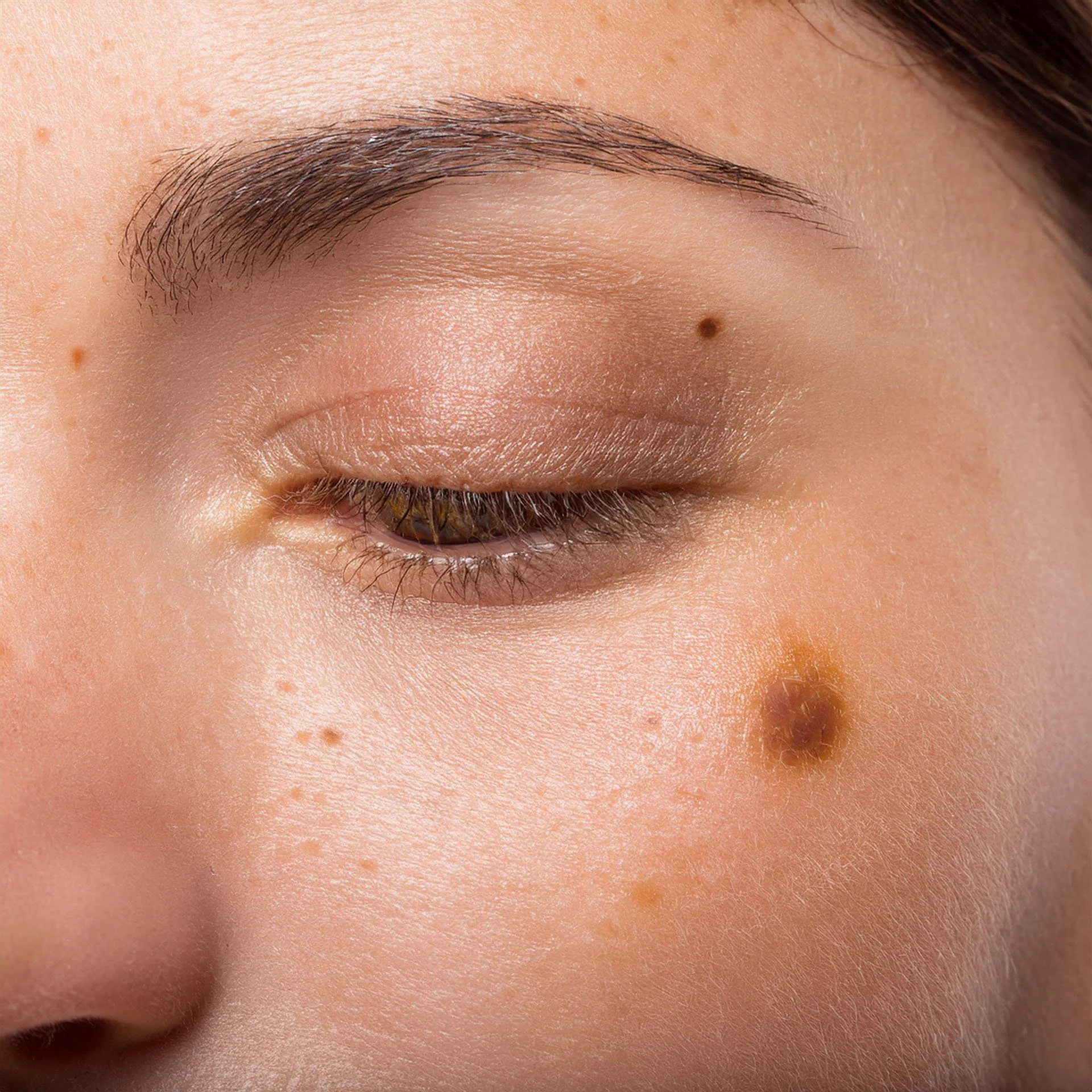 Actinic keratosis brisbane