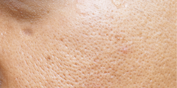 LaseMD for large pores brisbane