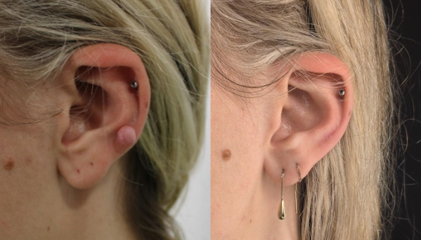 ear keloids treatment brisbane