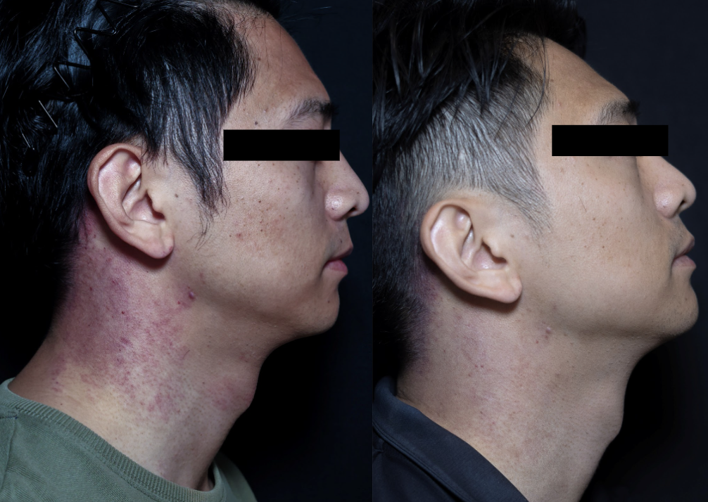 Port wine stain derma v rosacea