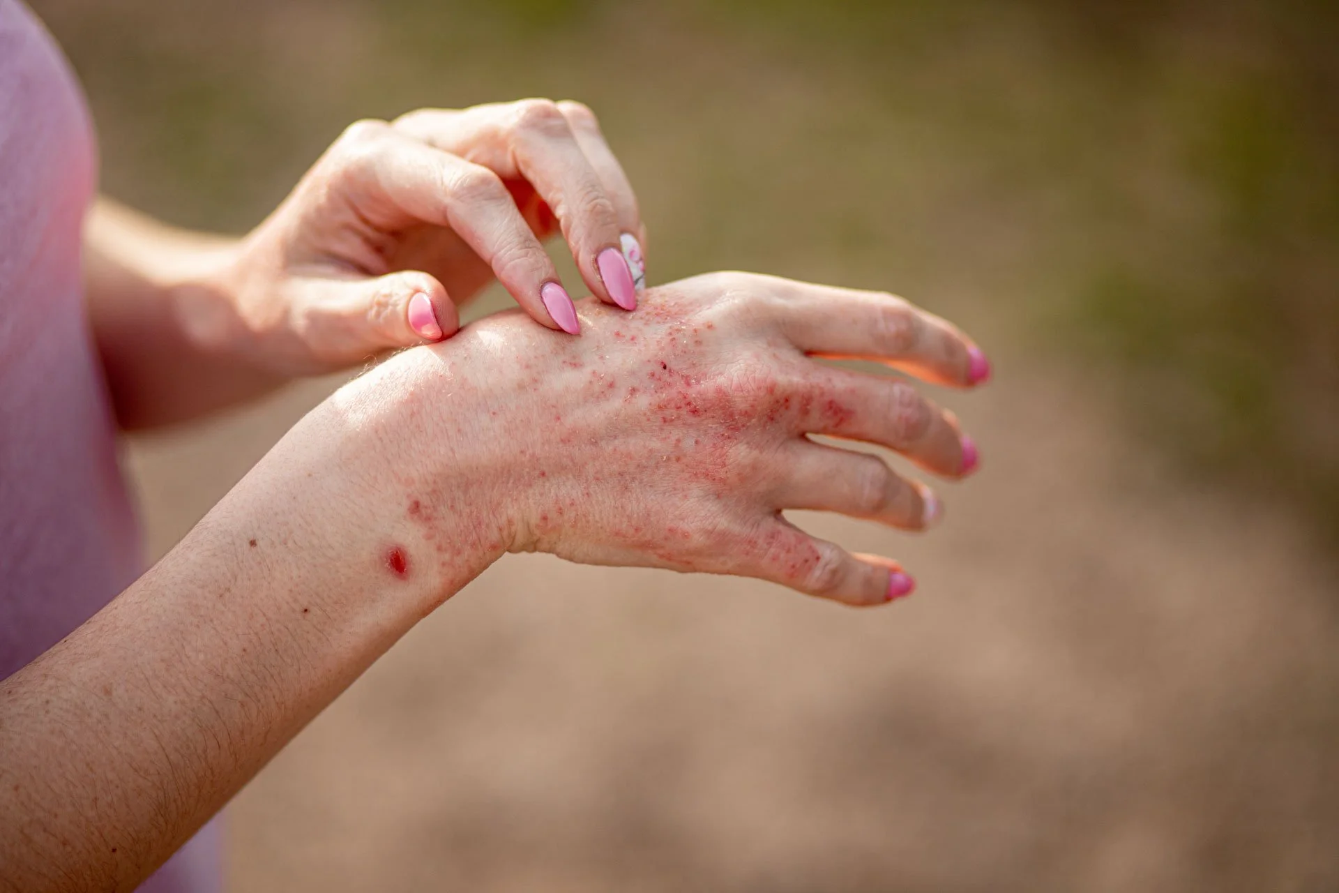 Brisbane eczema specialist