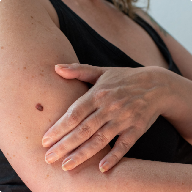 Skin cancer results