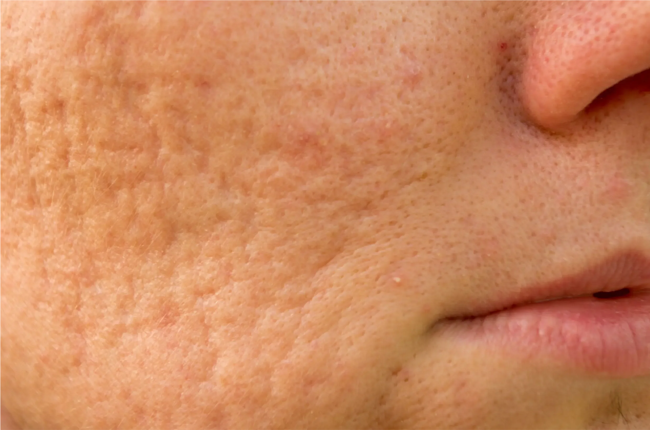 Close-up of a nose and surrounding facial skin.