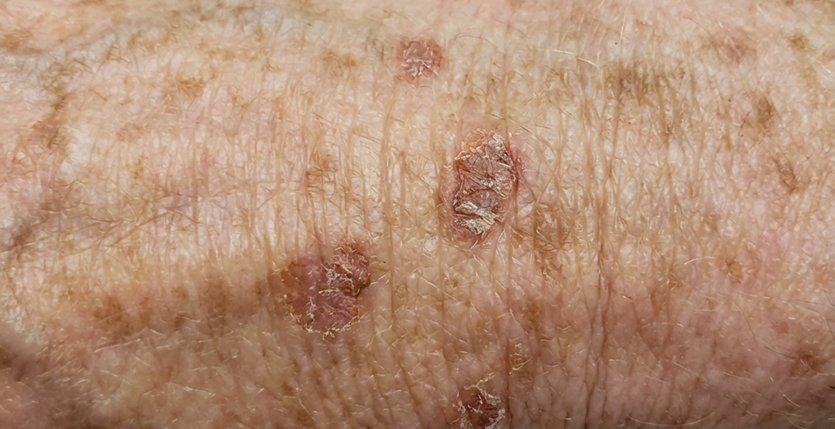 Actinic keratosis skin condition treated at Derm Skin Specialists in Brisbane