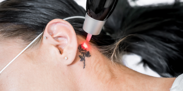 Tattoo Removal Brisbane - Picosure pro laser