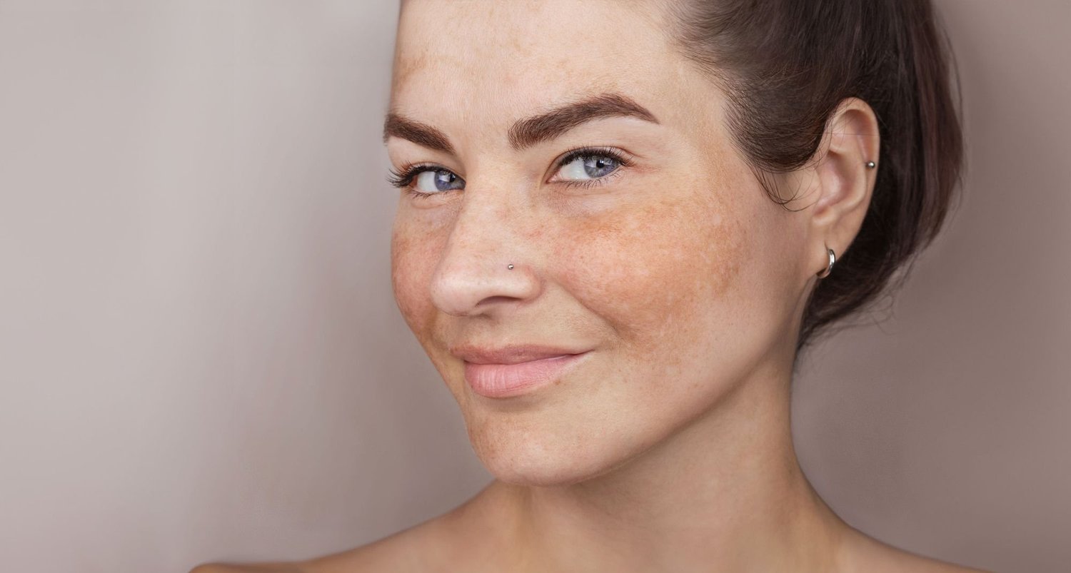 Woman with freckles and sun-related pigmentation across the cheeks and nose