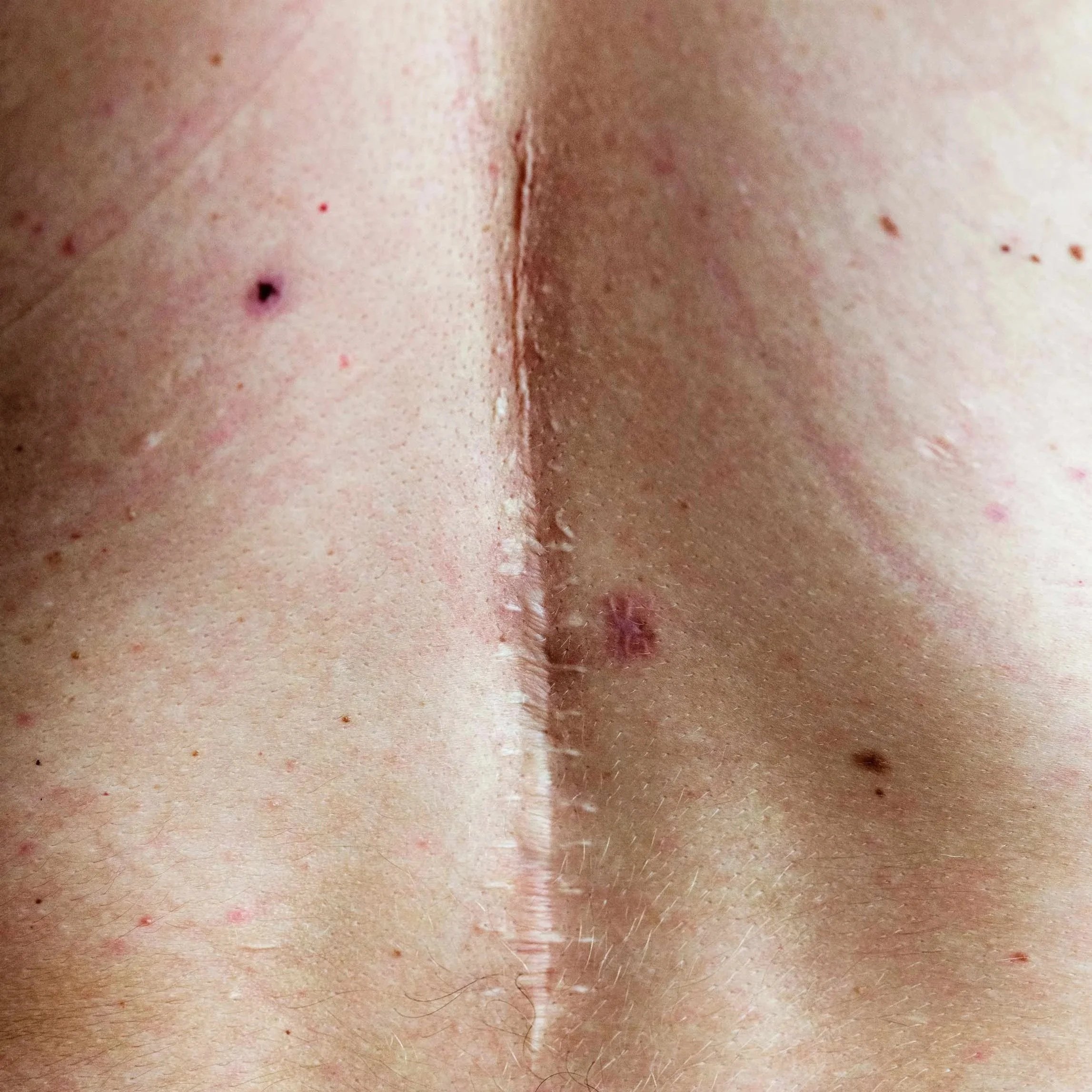 Close-up of human skin with small dark mole and tiny red spots.