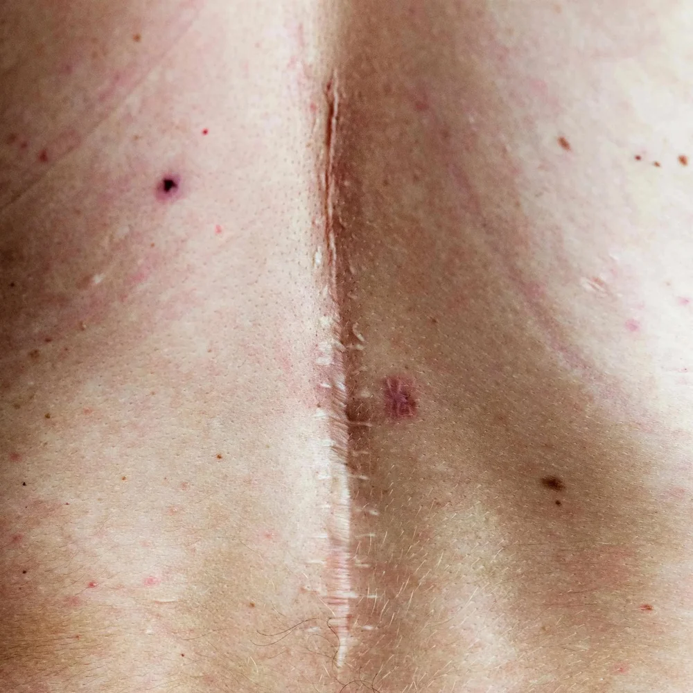 Long vertical surgical scar on the body, treated with scar revision at DERM Skin Specialists, Mount Gravatt