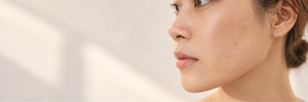 Close-up of ice pick and boxcar acne scars on the cheek