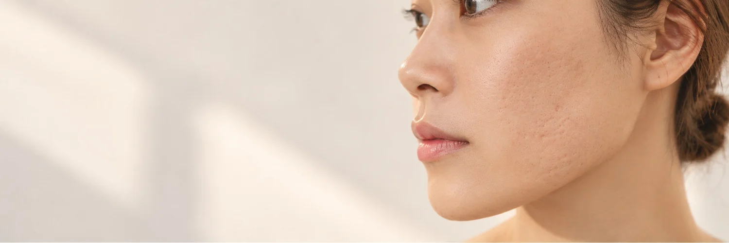 Close-up of ice pick and boxcar acne scars on the cheek