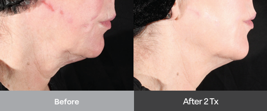 xerf collagen rebuilding brisbane