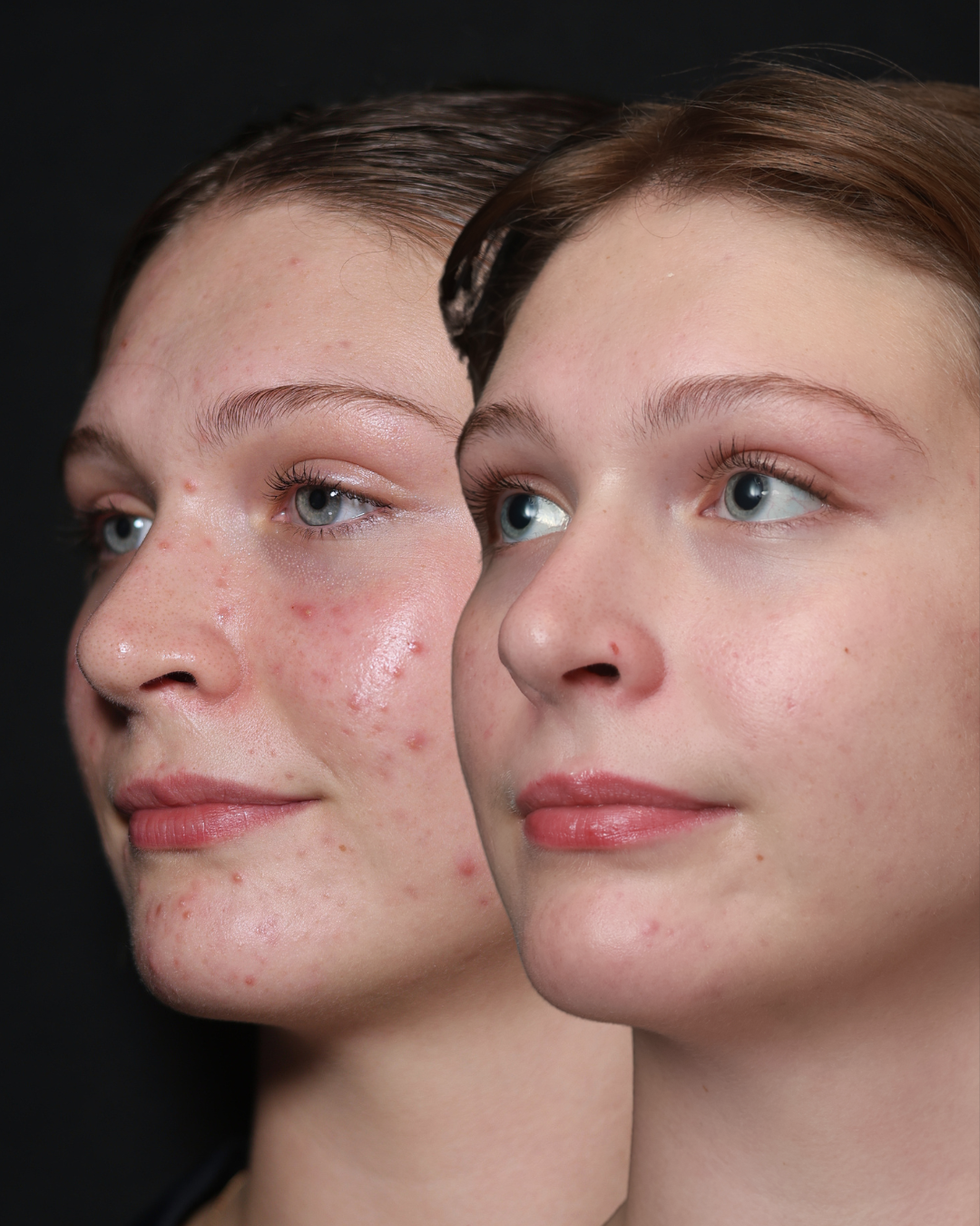 Before and after acne treatment: inflamed acne on the left, clearer skin 4 months after starting medical treatment on the right, DERM Skin Specialists, Mount Gravatt, Brisbane