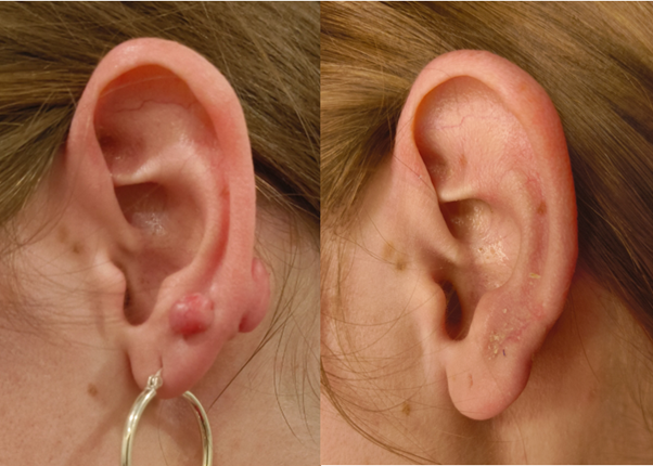 Keloids2.png