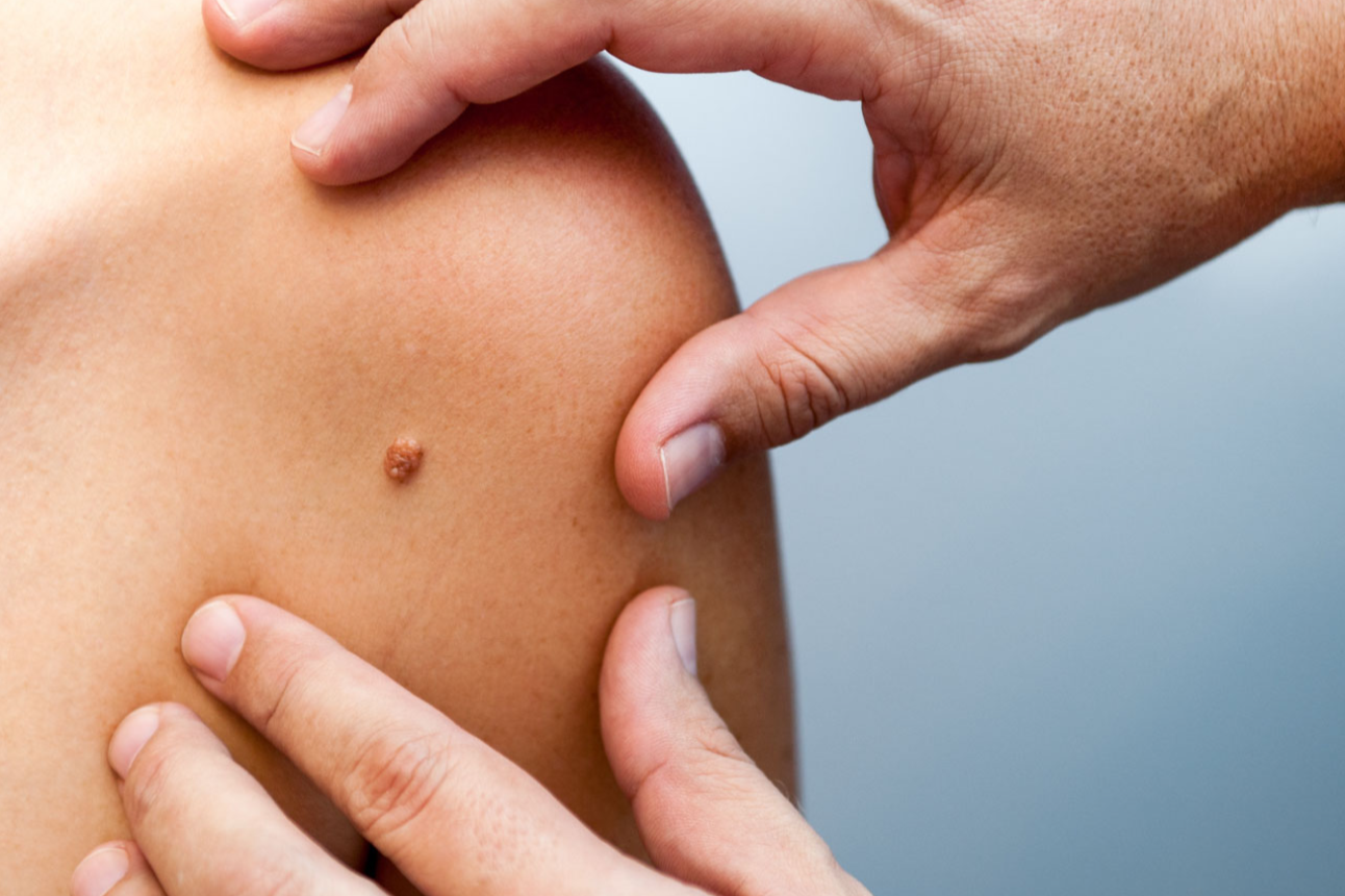 Skin Cancer Checks available within 1 week at Derm Skin Specialists in Brisbane.