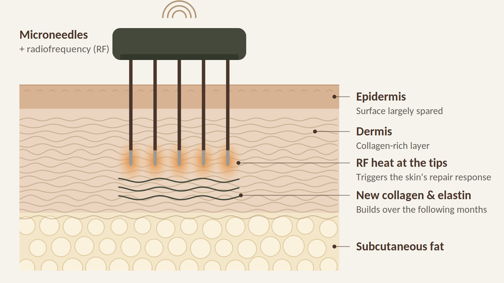 Diagram of Potenza RF microneedling: fine needles deliver radiofrequency heat into the deeper skin while the surface is largely spared