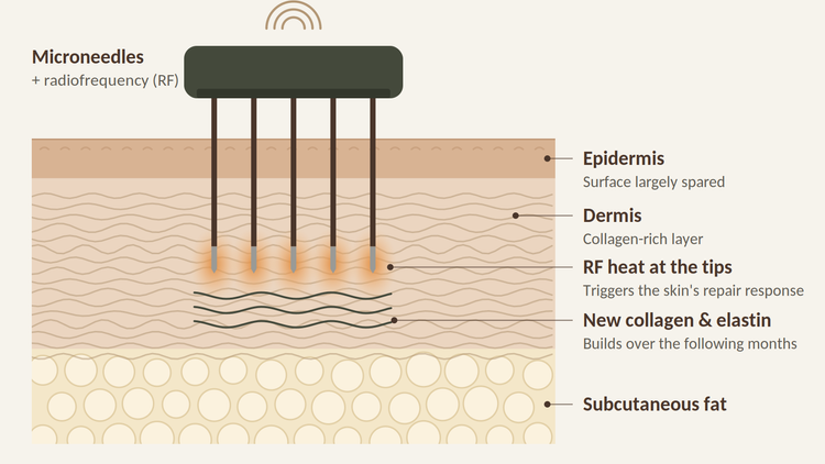 Diagram of RF microneedling delivering heat into the deeper skin