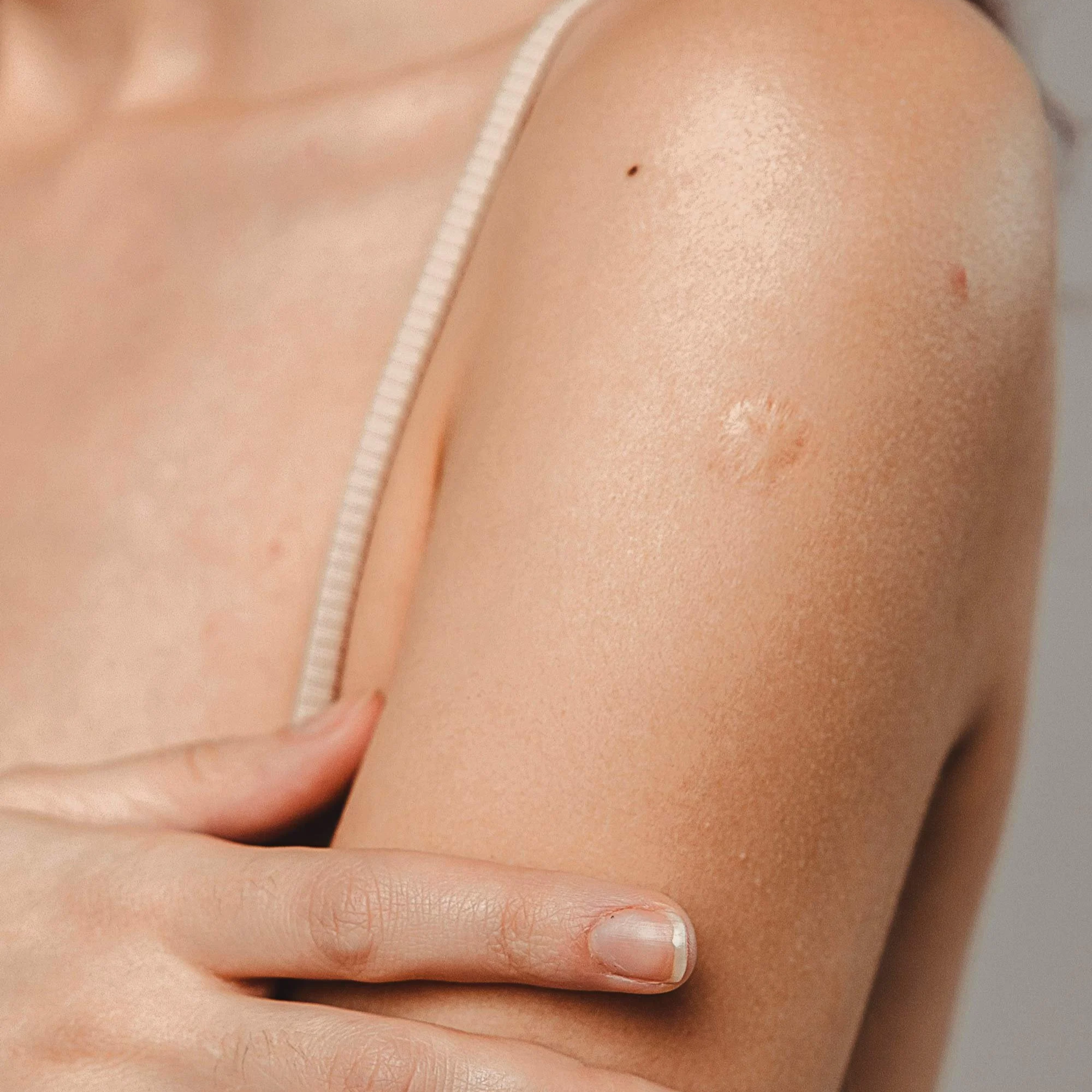 Raised keloid scars can be managed with the right care, at Derm Skin Specialists in Brisbane.
