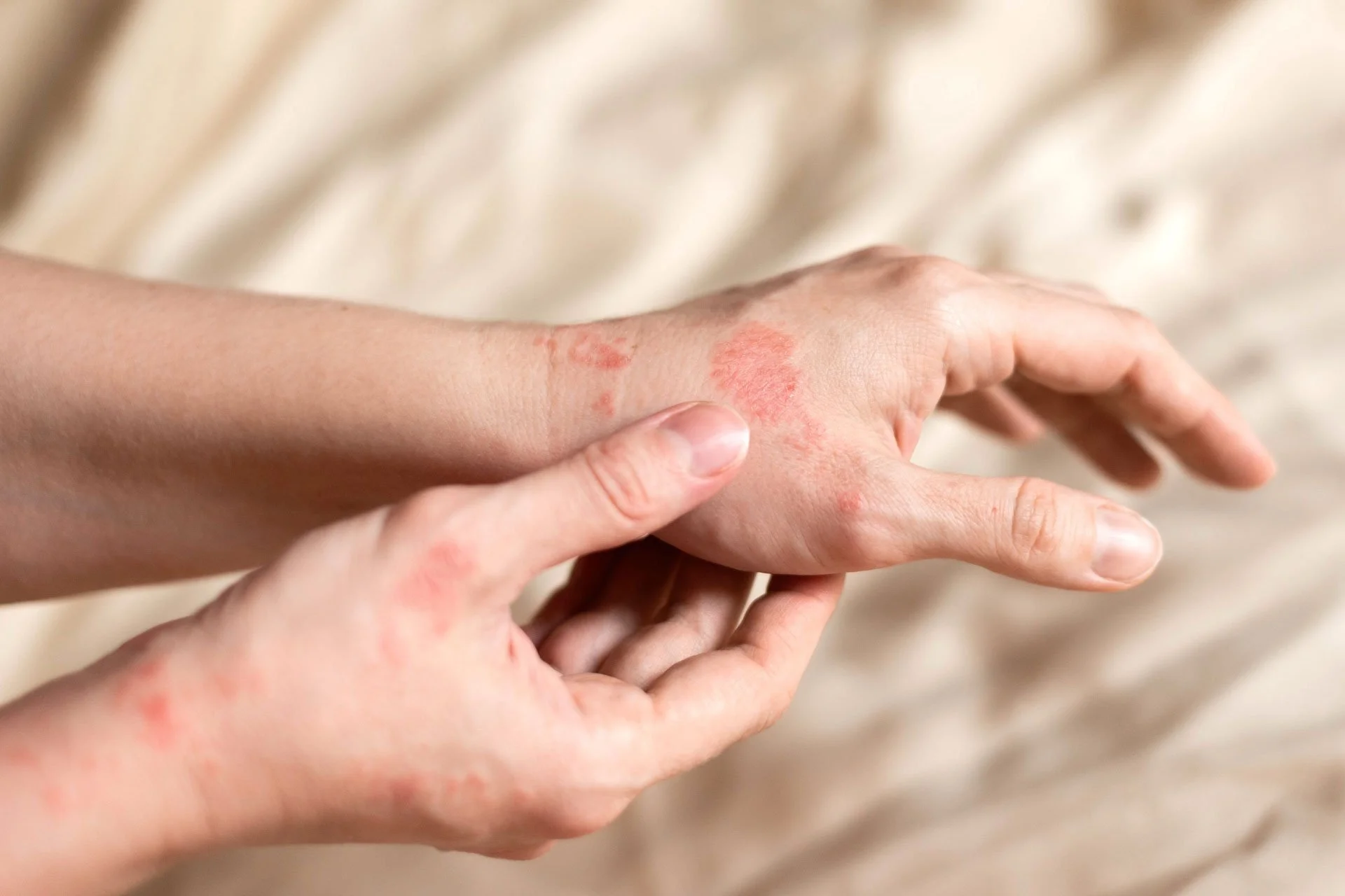 Brisbane dermatitis specialist