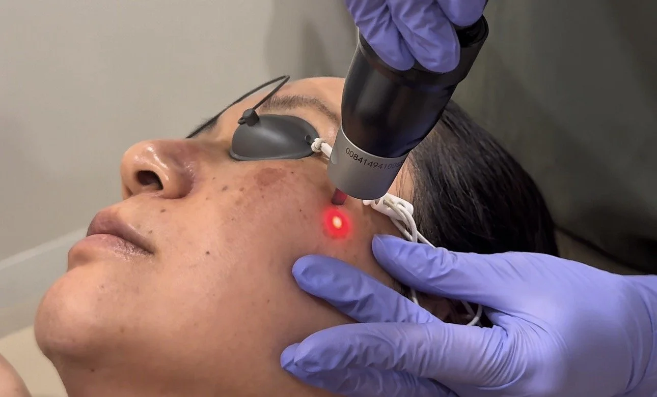 PicoSure Pro laser treating sun spots on a cheek at DERM Skin Specialists, Mount Gravatt