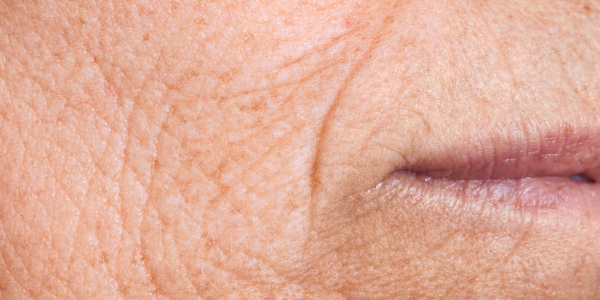 Fine Lines laser treatment wrinkles