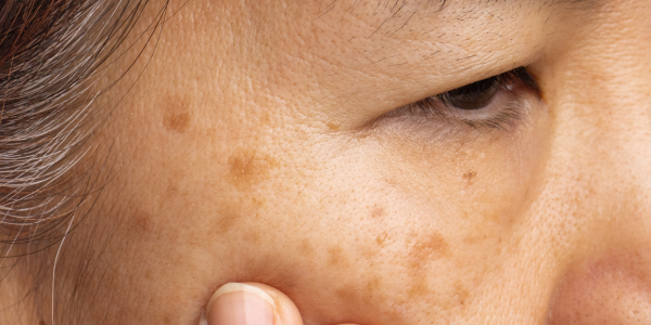 LaseMD for Melasma