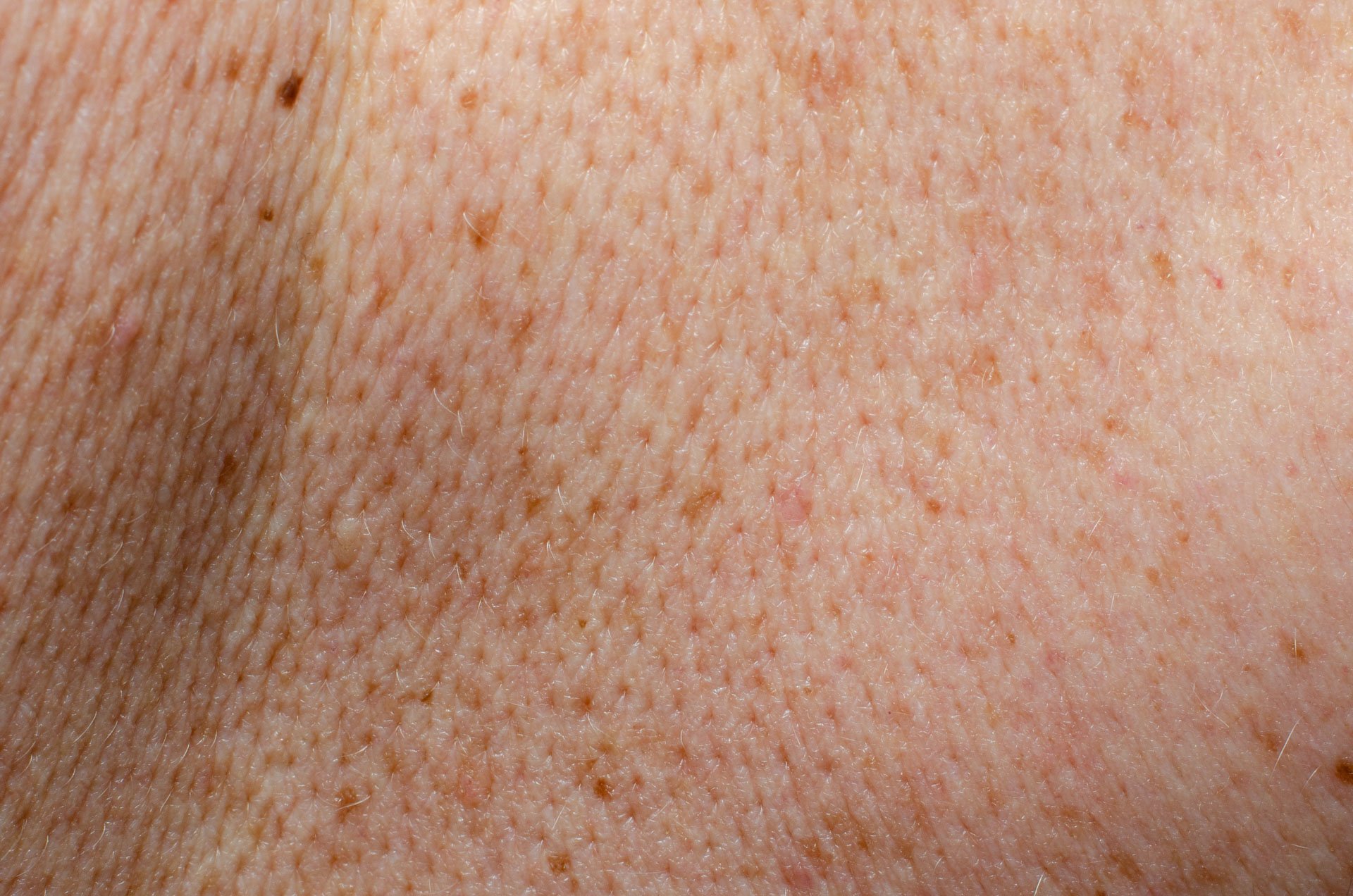 sun damage specialists brisbane