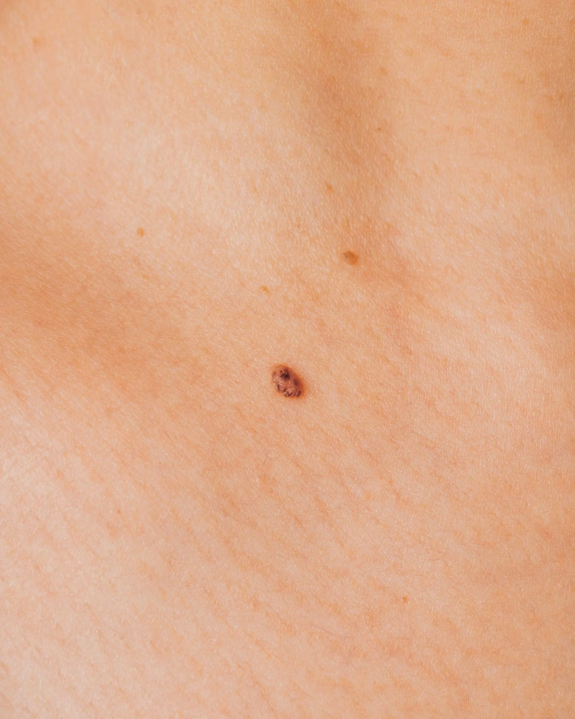 Skin Cancer Surgery in Brisbane