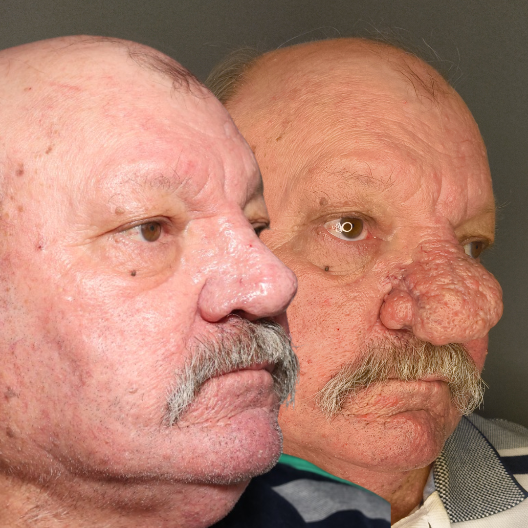 Rhinophyma results Brisbane