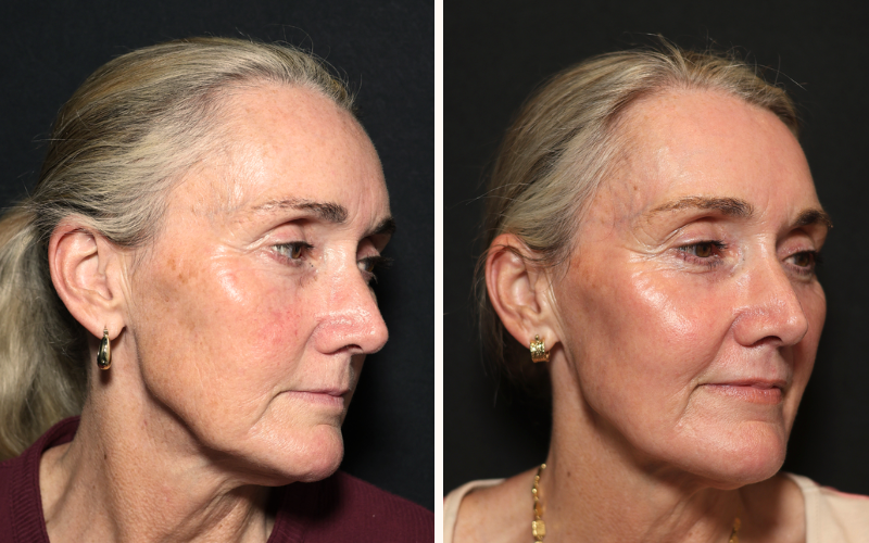 Before and after CO2 laser resurfacing Brisbane