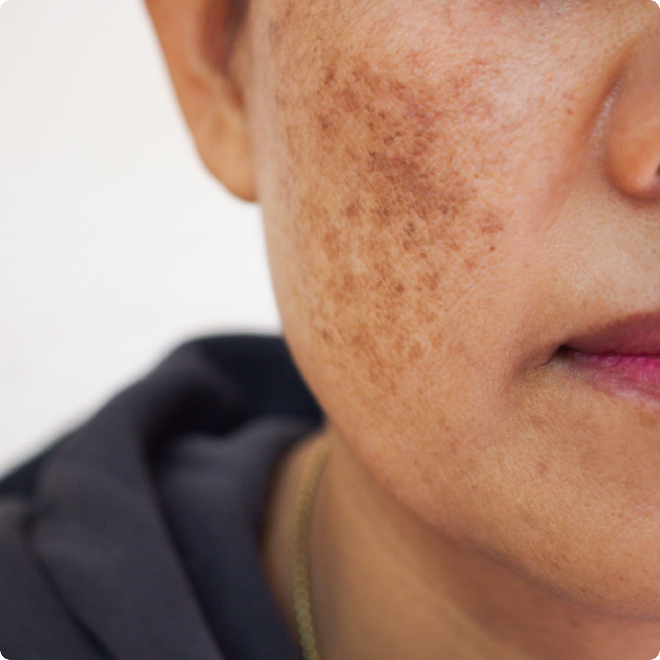 Pigmentation Specialists in Brisbane