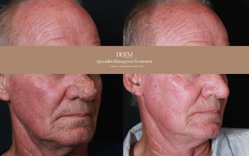 Man's nose with rhinophyma before and after one session of CO2 laser at DERM Skin Specialists, Mount Gravatt