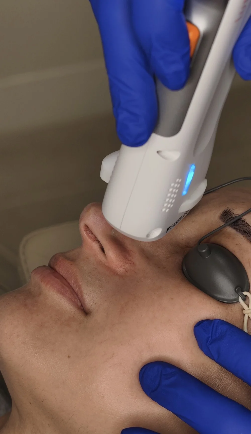 DermaV vascular laser handpiece used on a patient wearing eye protection at DERM Skin Specialists, Brisbane