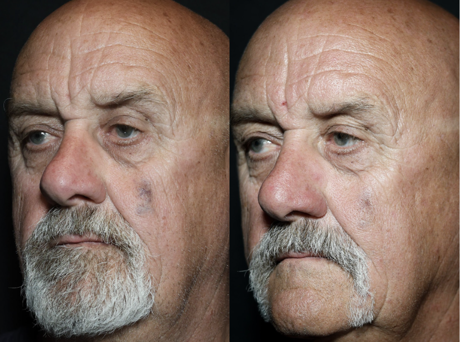 Vascular Lesion DermaV Laser