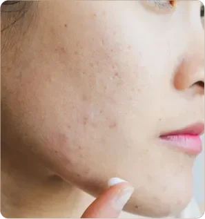 Close-up of a person's cheek showing acne scars and skin texture.