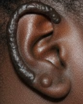 Keloid scar surgery in Brisbane at Derm Skin Specialists