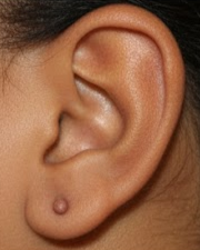 Keloid treatment provided by dermatologists at Derm Skin Specialists Brisbane