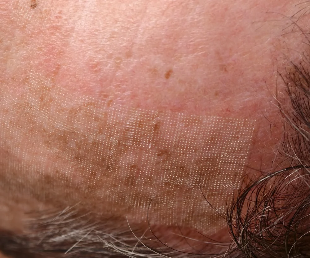 Skin straight after a LaseMD laser pass, the first step of laser-assisted PDT, showing a fine grid of treated dots