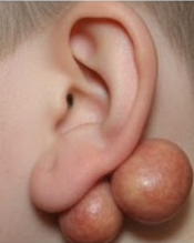 Keloid scar assessment and management at Derm Skin Specialists in Brisbane