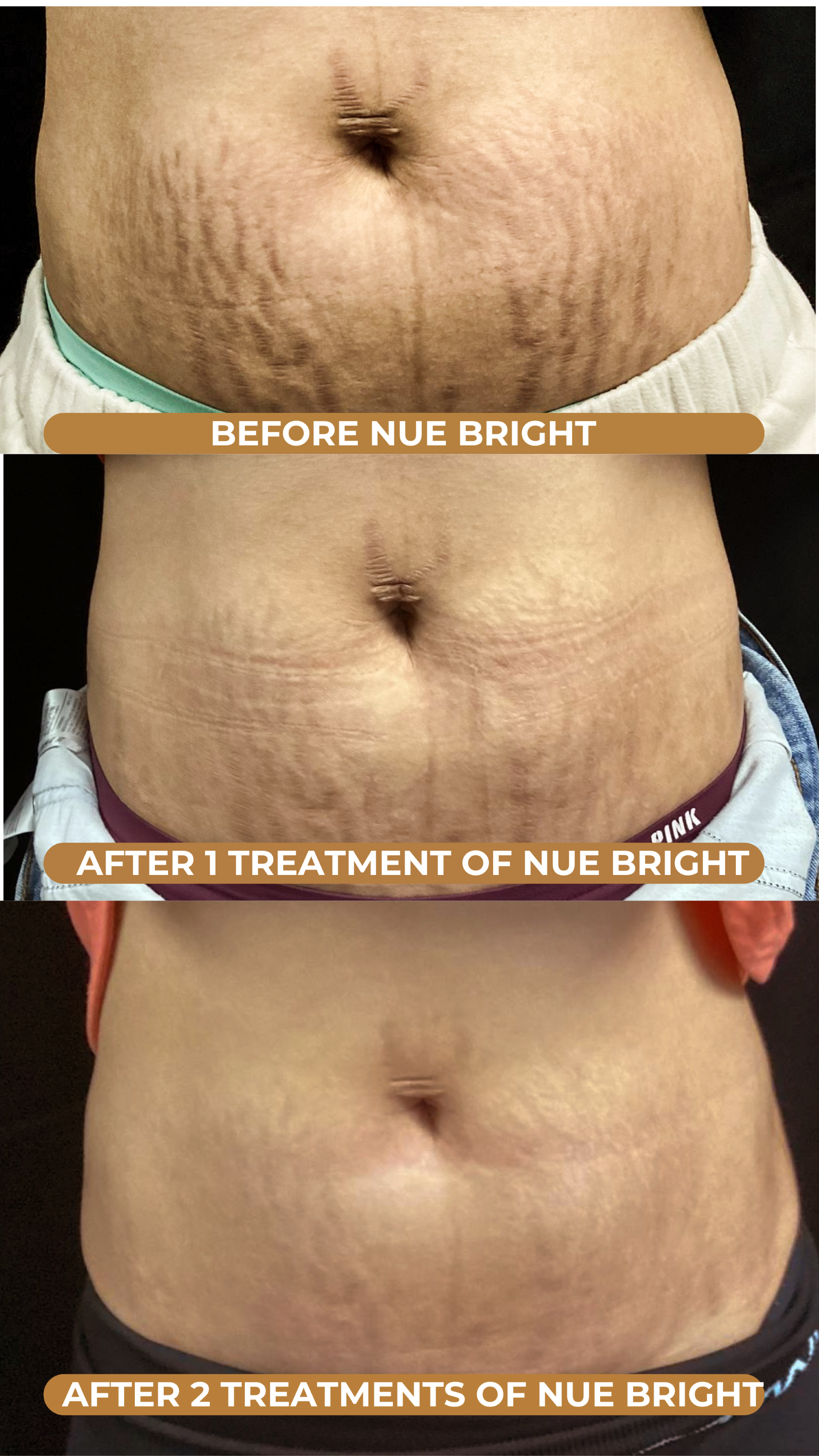 Before and after results of NUE Bright inkless stretch mark revision on abdomen, showing significant improvement in texture and tone after two treatments.