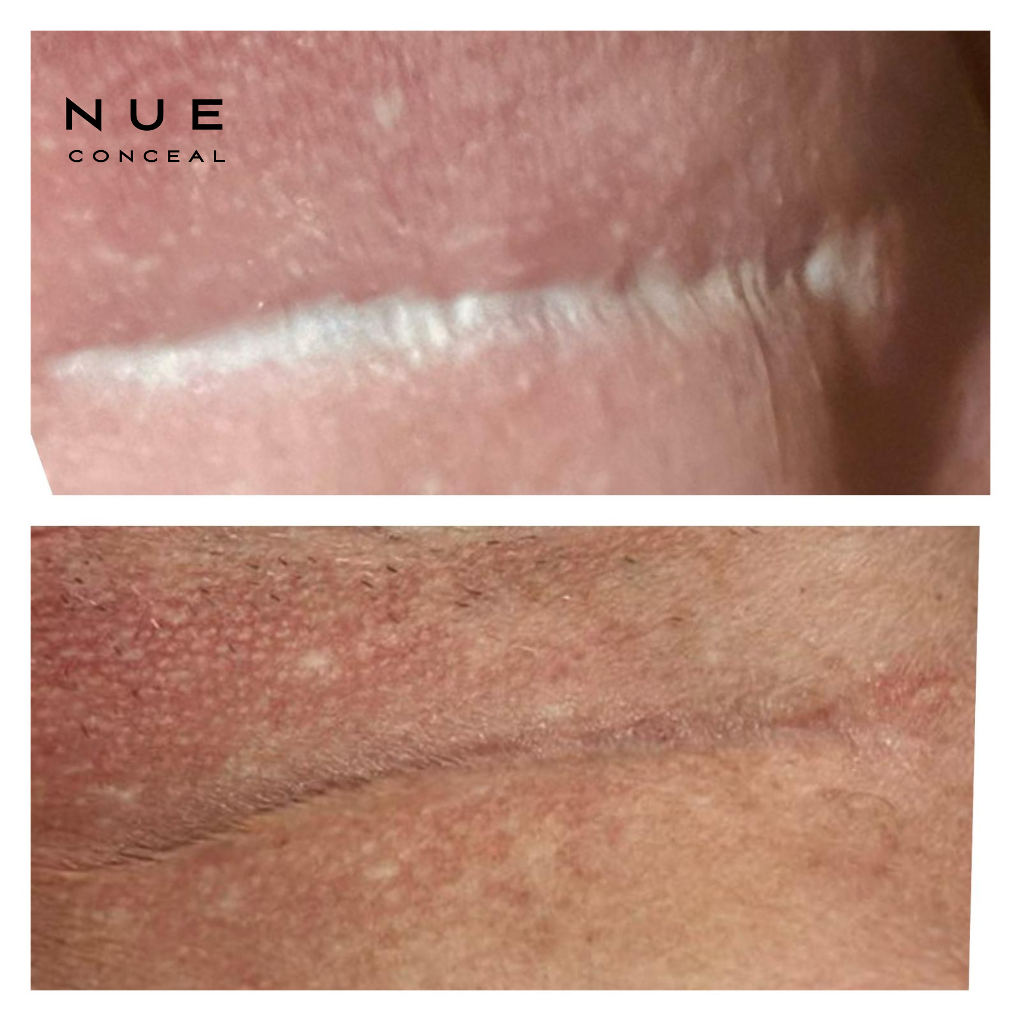 Before and after tummy tuck scar revision using NUE Conceal, showing improved texture through inkless regenerative serum treatments followed by camouflage tattooing to blend the scar with surrounding skin.