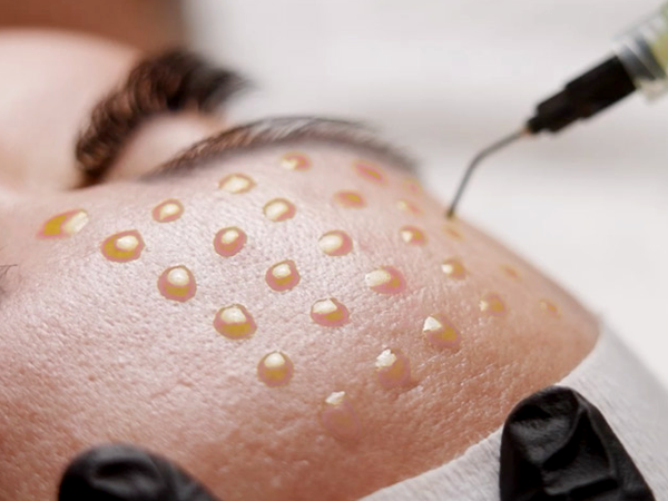 Corrective Peel Tucson