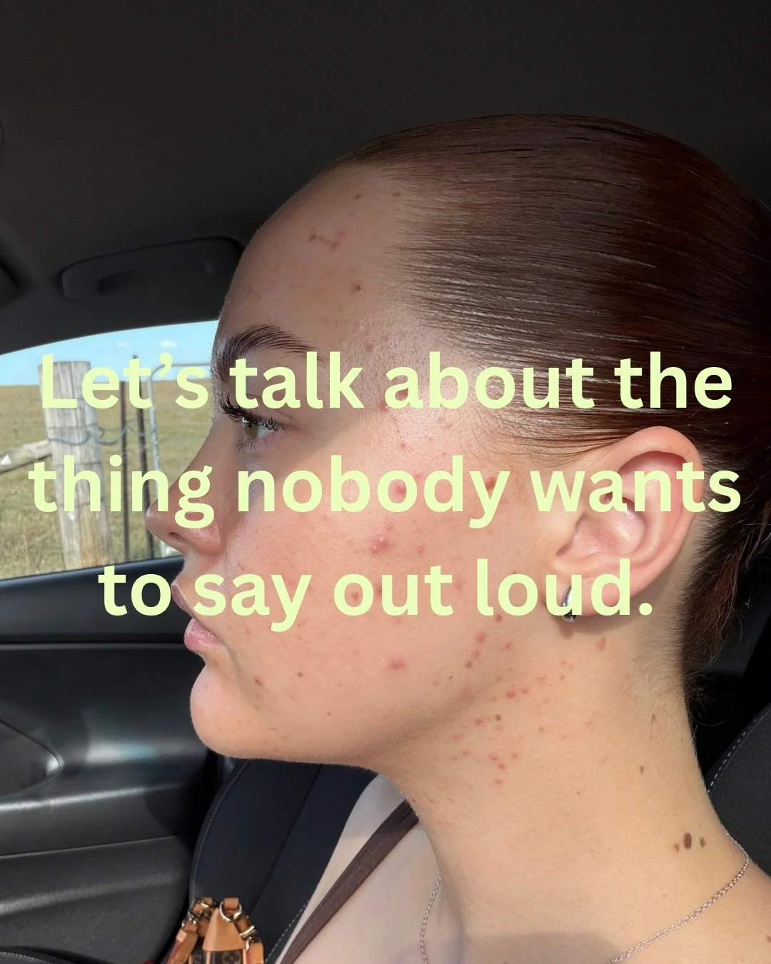Not gonna lie, this one&rsquo;s a bit raw for me. 

I work in skin every day and I still have mornings where I&rsquo;m picking myself apart in the mirror. If you&rsquo;ve ever cancelled plans, caked on extra foundation or avoided a photo because of y